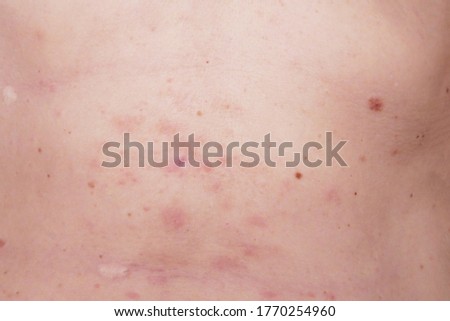 skin rash treatment on woman body. Shingles, Disease, Herpes zoster, varicella-zoster virus. skin rash and blisters on body. Background