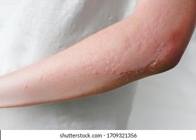 Contact Dermatitis Child Images Stock Photos Vectors Shutterstock