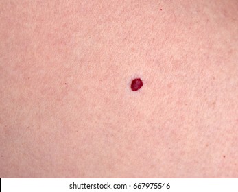 Angioma Images, Stock Photos & Vectors | Shutterstock