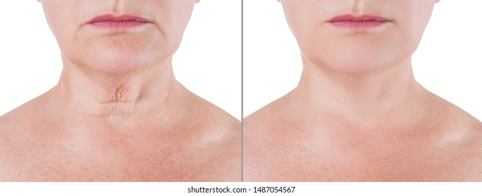 Skin rejuvenation on the neck, before after anti aging concept, wrinkle treatment, facelift and plastic surgery, half of body isolated on white background
