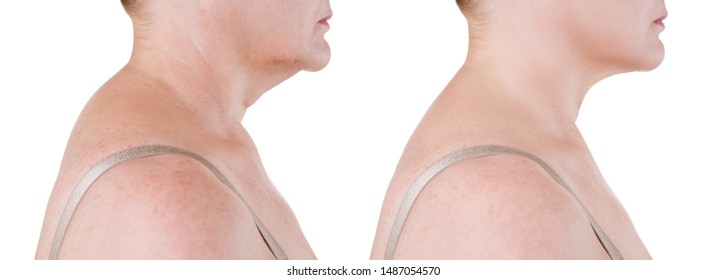 Skin rejuvenation on the neck, before after anti aging concept, wrinkle treatment, facelift and plastic surgery, half of body isolated on white background
