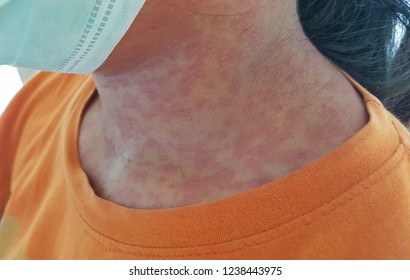 Skin Of Rubella Patient, Rubella Infection People, Skin Clinical Sign, Rash With Fever Patient