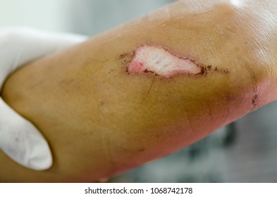 Skin Abrasion Images, Stock Photos & Vectors | Shutterstock