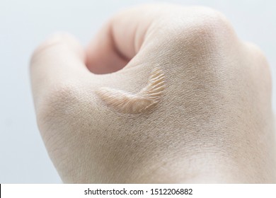 Skin Scar On The Right Hand