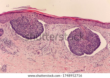 Skin section with a superficial multifocal basal cell carcinoma with retraction artifact. Microscopic view.