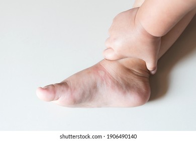 Skin Swelling Of Mosquito Bites On Baby Feet. Close-up
