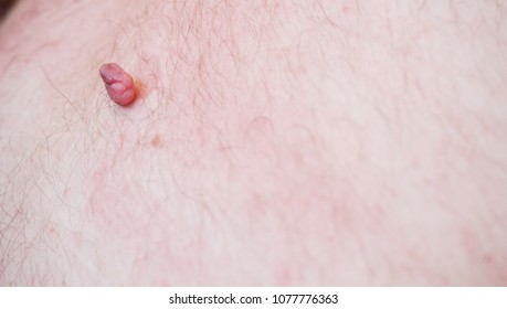 2,348 Skin Tag Women Images, Stock Photos & Vectors | Shutterstock