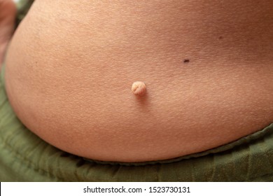 Acrochordon Hd Stock Images Shutterstock