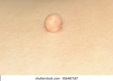 Skin Tag Or Acrochondon Or Soft Fibroma Is A Safe. It Have Not Effect To The Body. It Usually Occurs At Neck, Face, Armpits And Body.