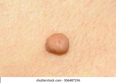 Skin Tag Or Acrochondon Or Soft Fibroma Is A Safe. It Have Not Effect To The Body. It Usually Occurs At Neck, Face, Armpits And Body.