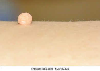 Skin Tag Or Acrochondon Or Soft Fibroma Is A Safe. It Have Not Effect To The Body. It Usually Occurs At Neck, Face, Armpits And Body.