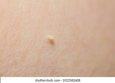 Skin Tag (acrochordon) Close Up