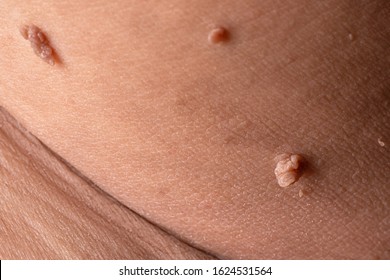 papilloma virus skin condilom diferență papilom