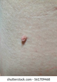 Skin Tag/Cutaneous Skin Tag/Acrochordon 