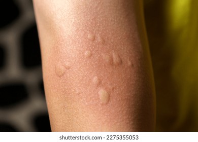 Skin texture, allergy shot, weeds, reaction Allergy symptoms Selective focus
