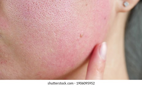 Skin Texture With Enlarged Pores. Irritated Red Skin Of The Face. Macro Skin. Skin Health And Care.