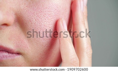 Skin texture with enlarged pores. Part of a woman's face
