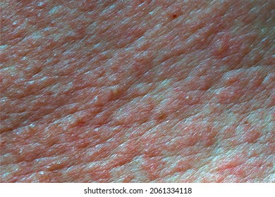 Skin Texture Painful Red Blisters Skin Stock Photo 2061334118 ...