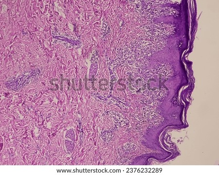 Skin tissue biopsy: Lichen planus. show skin tissue, epidermis show hyperkeratosis, acanthosis, saw-toothing of rete ridges. band like lymphohistiocytic infiltration. Dermatitides.