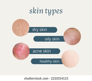 skin types, Skin Problems, Acne,oily, Dry  andhealthy - Shutterstock ID 2210314115