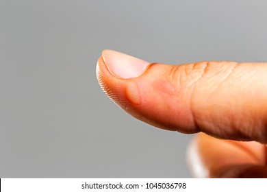 5,704 Skin ulcers Images, Stock Photos & Vectors | Shutterstock