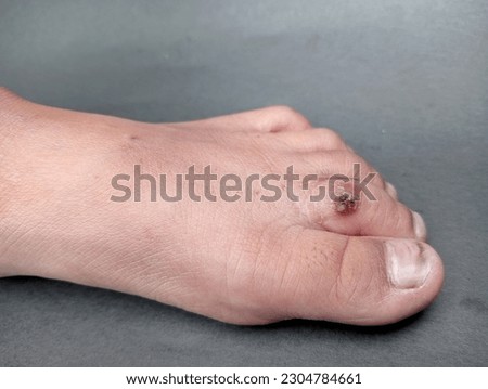 Skin warts or kutil on toes. The various warts types are caused due to the human papilloma virus (HPV). 