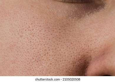 The Skin Of A Woman's Cheek With Clogged Pores Before Cleaning