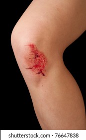 Skinned Or Scraped Bloody Knee