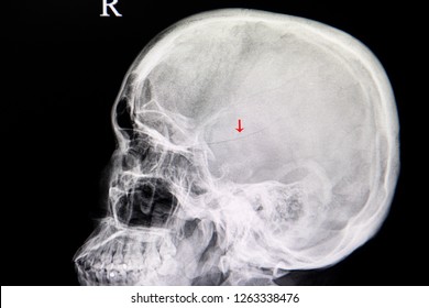 Skull Fractures Images, Stock Photos & Vectors | Shutterstock head exam diagram 