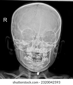 Skull x-ray image of Human skull AP view or front view isolated on Black Background.