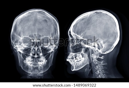  Skull x-ray image of Human skull  AP and Lateral  isolated on Black Background.