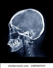 Skull Xray Image Human Skull Lateral Stock Photo 1489069319 | Shutterstock