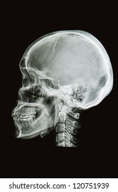 skull x-rays image  sagital plane