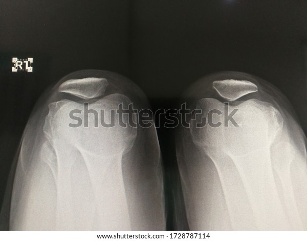 Skyline
view x-ray shows body of patella at both knee.
