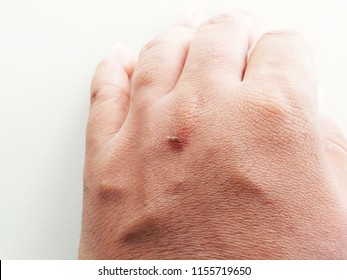 Slap Mosquito Bite.