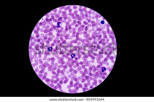 In slide blood smear show WBC, Neutroplil and\
RBC for complete blood count (CBC) test in microscope at hematology\
laboratory analysis.