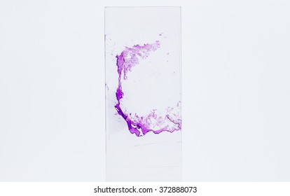 Slide Tissue Biopsy For Diagnosis In Pathology Laboratory.