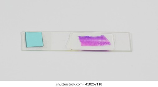 Slide Tissue Biopsy For Diagnosis In Pathology Laboratory.