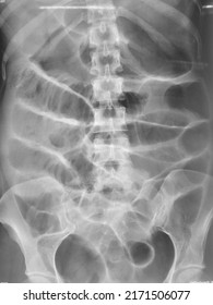 Small Bowel Dilatation On  Abdominal Xray. Patient Has Perforated Appendix. 