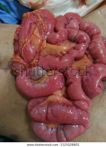 small bowel\
evisceration\
, blunt abdominal injury\
