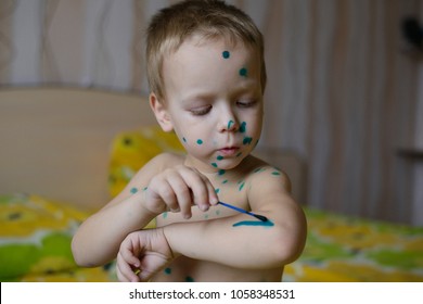 A Small A Boy With Chicken Pox, Lubricates Rashes Pan-green The Solution