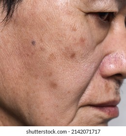 Small brown patches called age spots on face of Asian elder man. They are also called liver spots, senile lentigo, or sun spots. Closeup view.