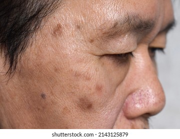 Small brown patches called age spots on face of Asian elder man. They are also called liver spots, senile lentigo, or sun spots. Closeup view. - Shutterstock ID 2143125879