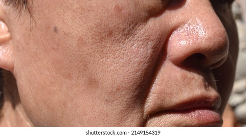 Small brown patches called age spots on face of Asian elder man. They are also called liver spots, senile lentigo, or sun spots. Closeup view.