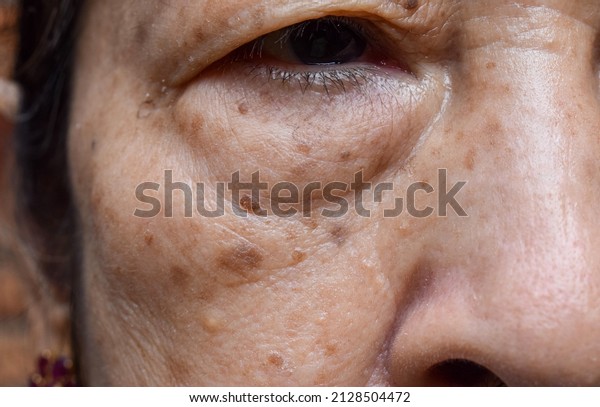 Small brown patches called age spots on face of\
Asian elder woman. They are also called liver spots, senile\
lentigo, or sun spots. Closeup\
view.