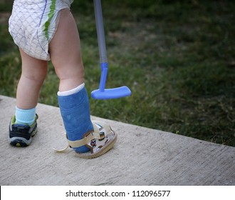 Small Child With Broken Leg In Cast