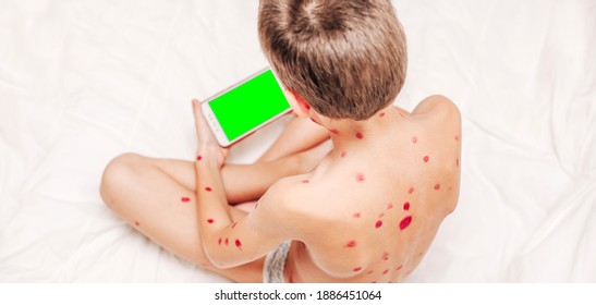 A Small Child With A Chicken Virus Sits On The Bed And Plays On The Phone. Varicella Virus. A Place For Text. Banner. Chicken Pox Concept. Medicine. Medical Concept. Close Up. Mock Up