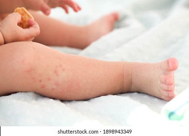 Small Child Red Rash On Leg Stock Photo (Edit Now) 1898943349