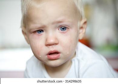 Small, Crying Toddler In Pain With Inflamed Eyes. Childhood Illnesses, Clumsy Phase, Hard Parenthood Concept. 