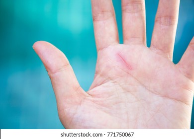 Small Cut Scar On Girl Hand Over Blurred Blue Background